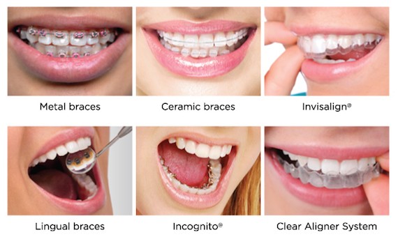 Types of Teeth Braces