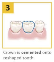 dental-crown procedure 3