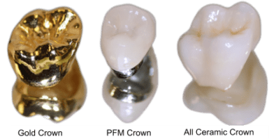 Types of Dental Crown