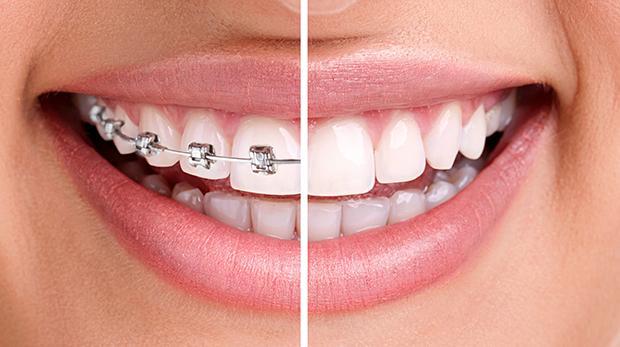 Dental Braces Types, Cost and Procedure - Nearby Dental