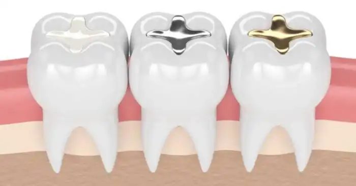 Dental Fillings  Procedure Details, Recovery Time & Cost Info