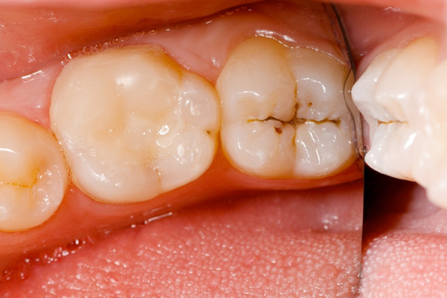 cavity molar cavities molars