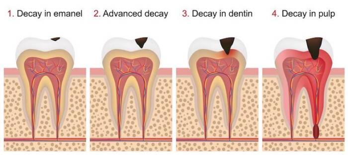 Dental decay stages